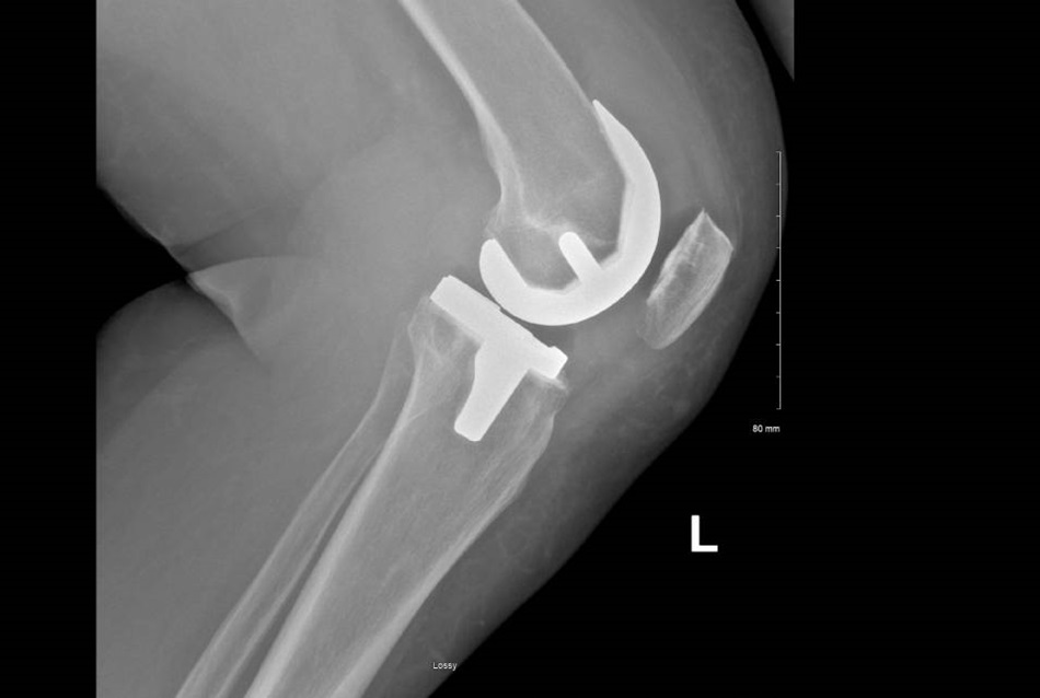 About care with Jonathan Miles X-ray of the Knee
